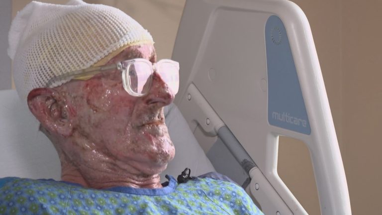 Man who survived sailboat explosion near Port Townsend shares story from burn unit
